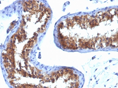 Staining with Mouse monoclonal MVP [Clone 1032] antibody in formalin-fixed paraffin-embedded human testicular carcinoma.
